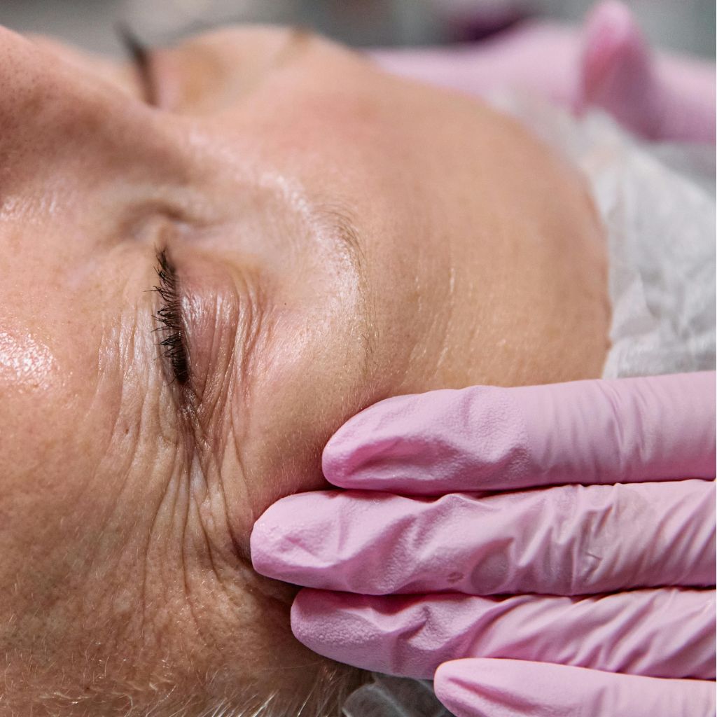 PDO Threads treatment procedure to lift and tighten sagging skin using non-surgical collagen-stimulating threads.